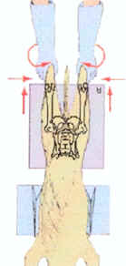 Displasia dell'anca - Posizionamento 4