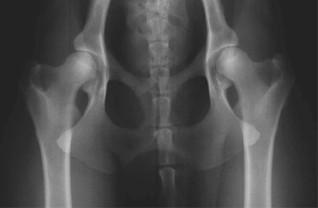 Displasia dell'anca - Classificazione grado normale