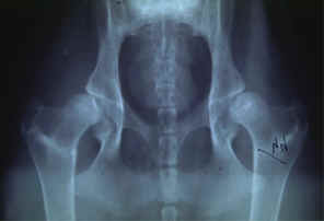 Displasia dell'anca - Classificazione grado media 1