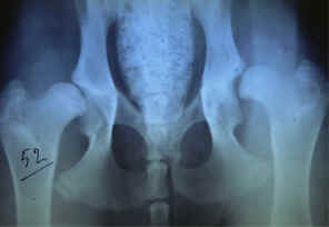 Displasia dell'anca - Classificazione grado grave