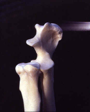 Displasia del gomito - Anatomia 3